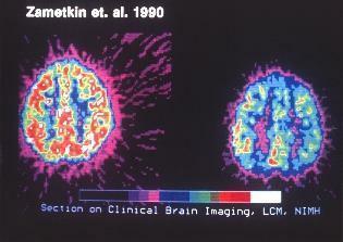 pemindaian pencitraan otak klinis untuk ADHD