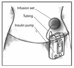 Pompa insulin