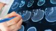 Pemindaian Otak 3D Dapat Meningkatkan Keakuratan Diagnosis ADHD
